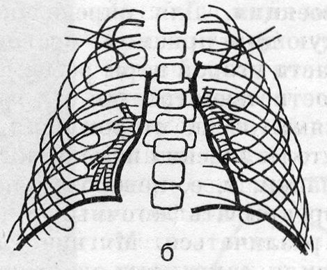 Схемы рентгенограмм органов грудной полости (б)