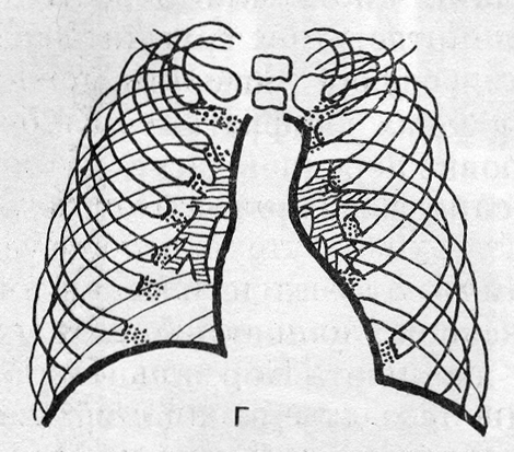 Схемы рентгенограмм органов грудной полости (г)