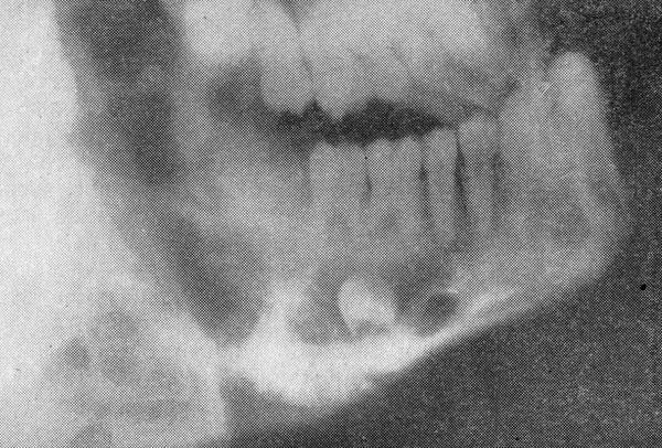  Боковая рентгенограмма — ретикулярная саркома нижней челюсти