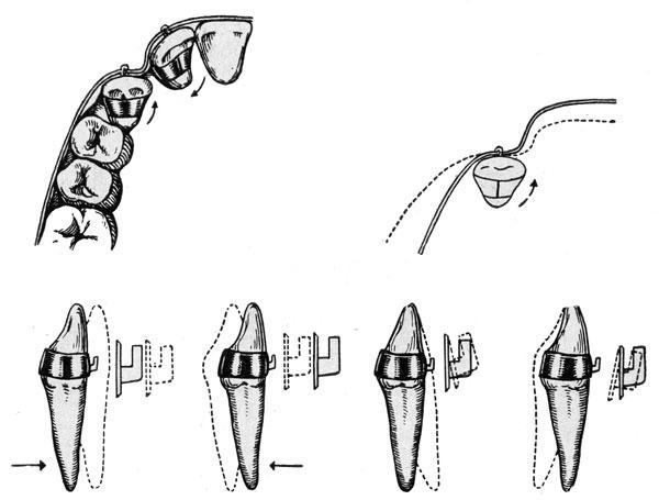 Аппарат Энгля с плоской дугой для корпусного перемещения зубов