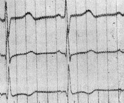 ФКГ верхушки сердца — низкоамплитудный первый тон — холосметодический шум