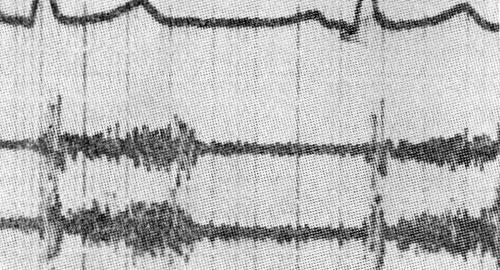 ФКГ верхушки сердца — холосистолический шум с поздним максимумом 