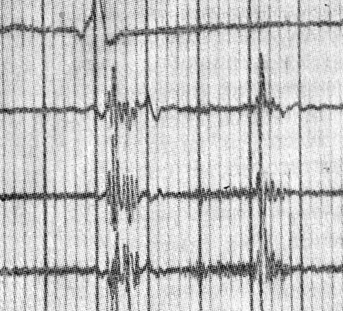 ФКТ верхушки сердца; поздний систолический шум после интервала (III тип по Schmidt—Voigt)