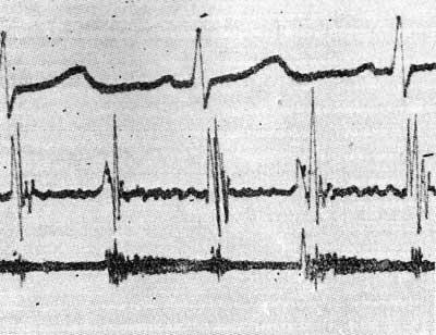 Холосистолический шум, начинающийся сразу после II тона у ребенка с недостаточностью аортального клапана
