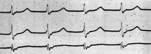 ЭКГ — в стандартных отведениях