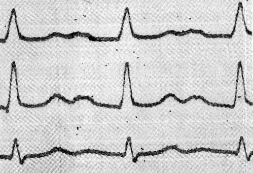 ЭКГ в стандартных отведениях индифферентный тип, синусовый ритм