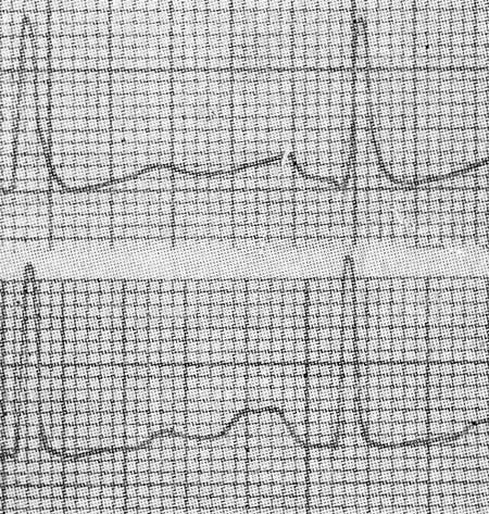 ЭКГ — стандартные I и II отведения, Р-митральный