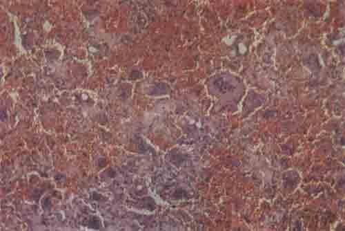 Микроскопическая картина ткани при остеобластокластоме