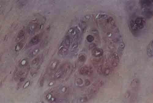 Микроскопическая картина ткани при дисхондроплазии