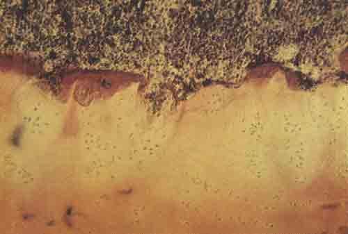Микроскопическая картина ткани при спонтанном рассасывании костей
