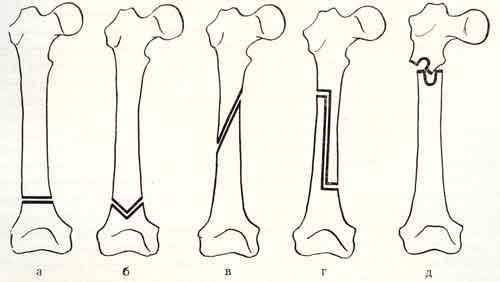 Виды остеотомии