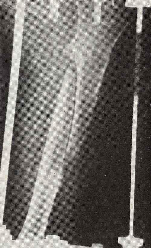 Рентгенограмма бедра после косой остеотомии ультразвуковой пилой