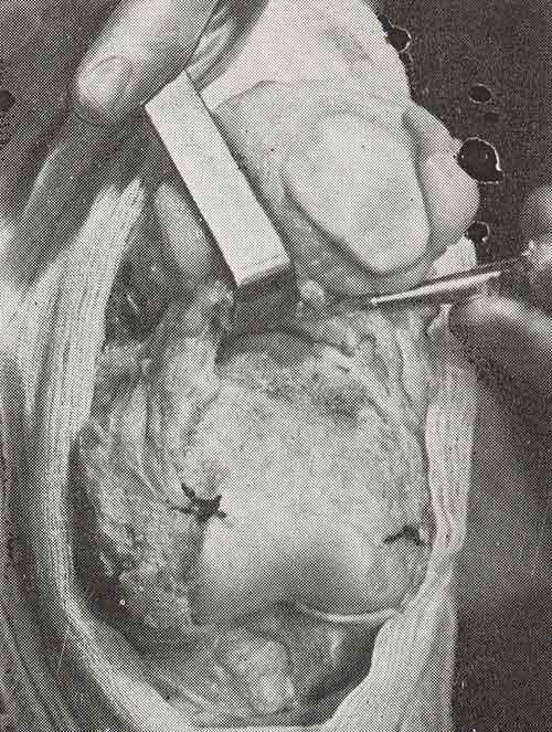 Соединение гомотрансплантата ультразвуковой костной мозолью с материнской костью