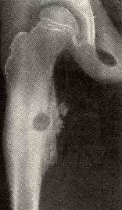 Кортикальная остеоид-остеома бедренной кости с утолщением метафиза в области гнезда опухоли