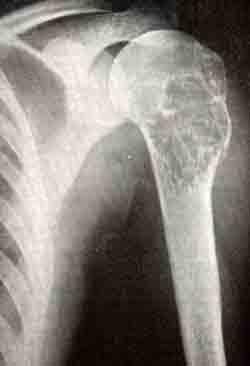 Первично злокачественная остеобластокластома плечевой кости