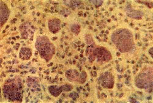 Микроскопическая картина остеобластокластомы