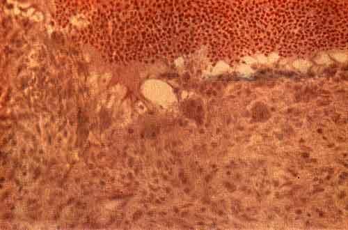 Скопление эритроцитов, окруженное гигантскими клетками в остеобластокластоме