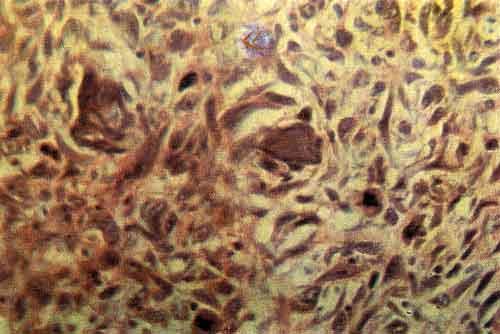 Микроскопическая картина остеогенной саркомы