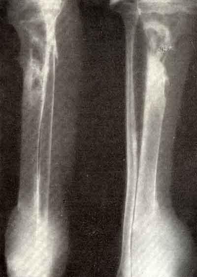 Первичный очаг остеогенной саркомы большеберцовой кости и метастаз в ту же кость