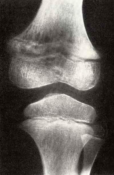 Физарная хондрома дистального отдела бедренной кости у мальчика 7 лет