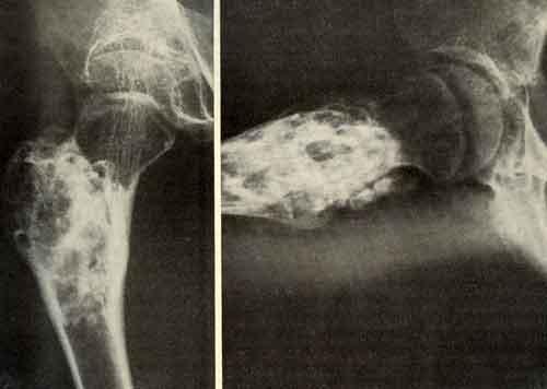 Хондробластома вертельной области бедренной кости у девочки 13 лет