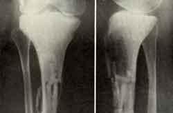 Хондробластома большеберцовой кости после резекции суставного конца и гомопластики