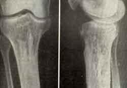Хондробластома большеберцовой кости у девочки 12 лет после резекции и гомопластики методом «вязанки хвороста»
