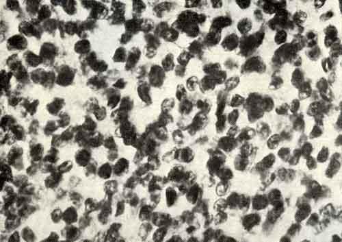 Микроскопическая картина опухоли Юинга