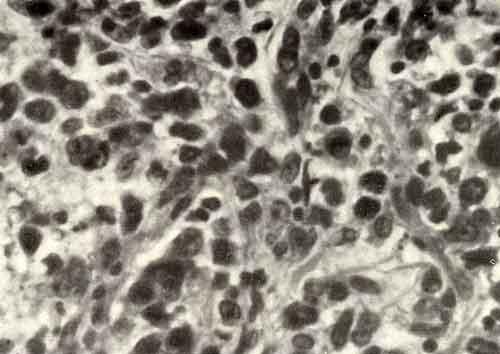Микроскопическая картина ретикулоклеточной саркомы кости