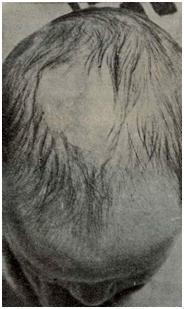 Aplasia cutis congenita