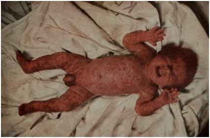 Pemphigus epidemicus neonatorum у ребенка 16 дней