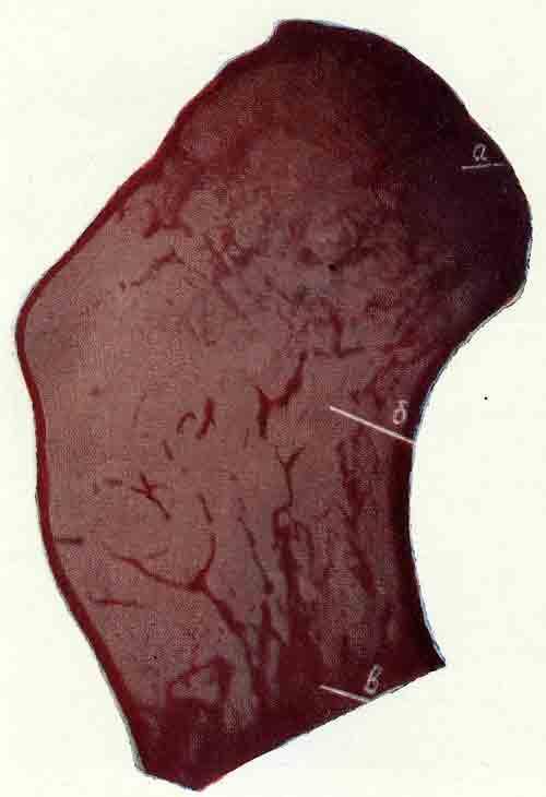 Микроскопическая картина экзостоза