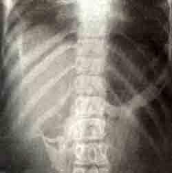 Оссифицирующий миозит: рентгенограмма позвоночника и грудной клетки