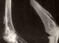 Оссифицирующий миозит: рентгенограмма локтевого сустава