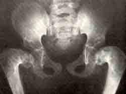Варусная деформация нижних конечностей на почве ахондроплазии: рентгенограммы тазобедренных суставов