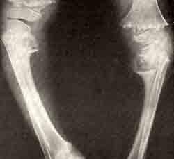 Варусная деформация нижних конечностей на почве ахондроплазии: рентгенограммы коленных суставов