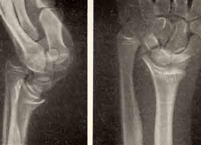 Рентгенограмма лучезапястного сустава