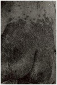 Dermatitis seborrhoides — erythema glutaeale 