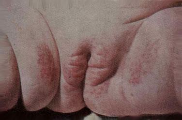 Dermatitis seborrboides — intertrigo у 9-месячной девочки