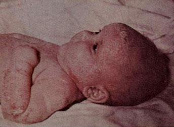 Себоройдный дерматит у 5-месячного ребенка