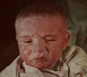 Dermatitis seborrhoides larvalis у 6-месячного ребенка