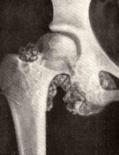 Рентгенограмма ребенка 9 лет с хондроматозом правого тазобедренного сустава