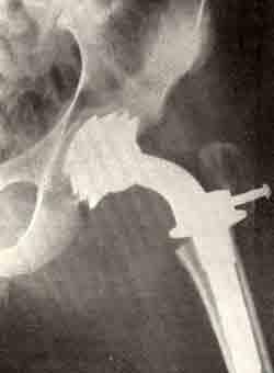 Рентгенограмма после аллопластики тазобедренного сустава по Сивашу