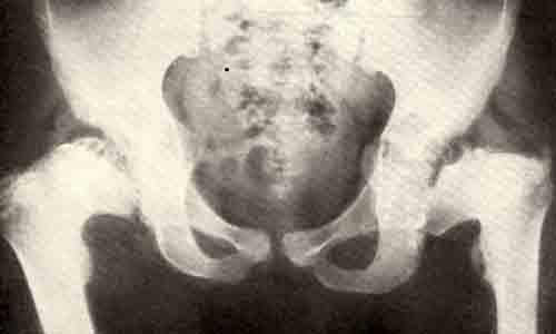 Рентгенограмма тазобедренных суставов