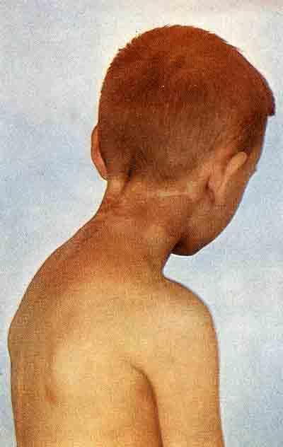 Пигментные пятна на коже шеи при синдроме Олбрайта у мальчика 9 лет
