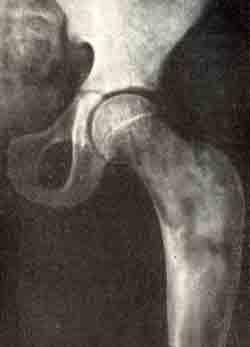 Стадии фиброзной остеодисплазии в рентгеновском изображении