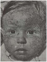 Eczema infantum у 11-месячного мальчика
