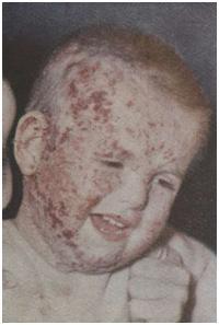 Eczema infantum у ребенка 2 лет