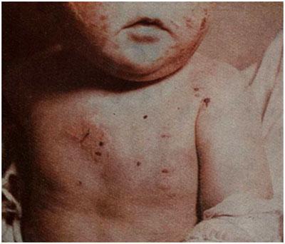 Eruptivo varieliformis Kaposi у 8-месячного ребенка