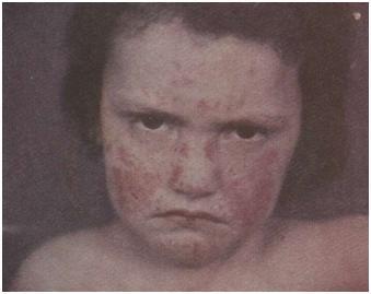 Prurigo Besnier у 5-летнего мальчика